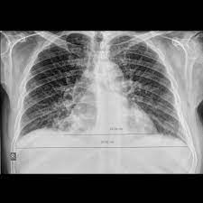 Name bilateral pleural eﬀusion and. Cardiomegaly With Bilateral Pleural Effusion Radiology Case Radiopaedia Org