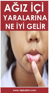 Agiz Ici Yaralarina Ne Iyi Gelir Www Vipbakim Com Saglik Saglik Ipuclari Saglikli Yasam Tarzi