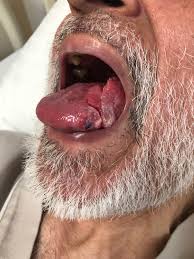 Image result for cancer of tongue