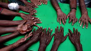We are an international charity working to #beatleprosytogether. Alte Krankheit Immer Noch Eine Gefahr