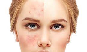 31,516 Acne Face Stock Photos, Pictures & Royalty-Free Images - iStock