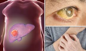 Learn about cancer warning signs women should watch for. Liver Cancer Symptoms Stomach Pain And Vomiting Are Signs Of Deadly Disease Express Co Uk