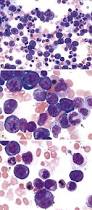 Image result for Microcytic Anemia