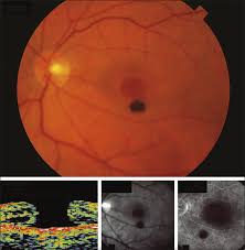 Black Operculum In Full Thickness Macular Hole Eye Health Holes Eyes