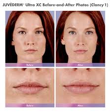 The price tag of juvederm voluma can differ significantly between two treatment providers. Juvederm Products Albuquerque Voluma Santa Fe