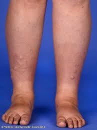 The result, known as hyperthyroidism. Skin Signs Of Thyroid Disease Hypothyroid Mom