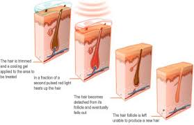 If you don't target the follicle, the hair will just keep coming. Welcome To Isb Imperial Smile Beauty