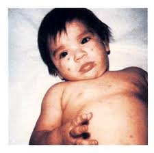 Image result for Rickettsialpox