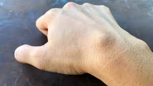 Image result for Cyst