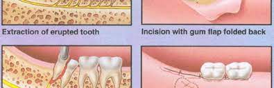 We did not find results for: Cost Of Wisdom Tooth Removal Extraction Thornhill Dentist North York Dentistry Yonge Steeles