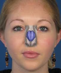 Meaning of spreader graft medical term. Placing Spreader Grafts