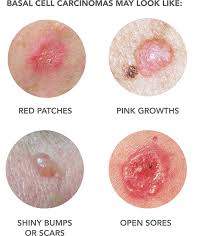 Skin dermatitis is an umbrella term describing inflammation of the skin. Carcinome Dermtech