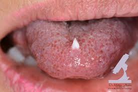 Image result for papillomavirus tongue)