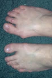 This Is What Rheumatoid Arthritis Has Done To My Poor Feet My Right Foot Is What Is Rheumatoid Arthritis Rheumatoid Arthritis Rheumatoid Arthritis Awareness