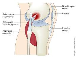 Om du trykker på stedet der det gjør vondt føles det nesten som å trykke på en pose potetmel. Popliteustendinopati Nhi No