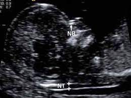 An nt scan is a common screening test that occurs during the first trimester of pregnancy. Normal Nuchal Translucency Nt And Normal Nasal Bone Assessment Download Scientific Diagram