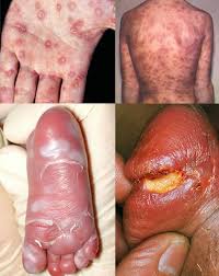 Image result for syphilis symptoms