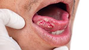 Image result for dental cancer