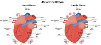 What foods trigger atrial fibrillation? Atrial Remodeling For Atrial Fibrillation