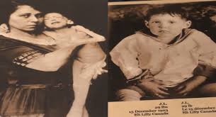 Banting, who recorded that her skin was scaling and hair brittle and falling out due to starvation. dr. Marking 100th Anniversary Of Dr Frederick Banting Discovering Insulin Ctv News