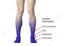 What's more, diabetes is linked to a condition called peripheral arterial disease (pad), which lessens blood flow to your legs and feet. Diabetic Neuropathy Illustration Stock Image C025 7552 Science Photo Library