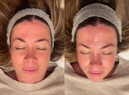 Janet Dunleavy, BSN RN, LME