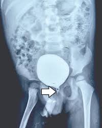 Image result for Voiding Cystourethrogram