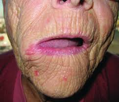 Cherry angioma or senile angioma or campbell de morgan spots are common skin growth that can occur in most areas of your body. Angioma Taber S Medical Dictionary