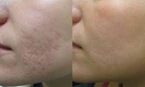 Laser treatment cannot get rid of a scar. Fraxel Restore Laser Rejuvenation Acne Scar Pre 1 The Cosmetic Vein Laser Center