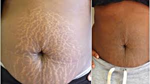 Just Rub Your Skin With This Spice And The Wrinkles Will Disappear Top 5 Diy Lighten Stretch Marks Anti Aging Skin Products Stretch Marks