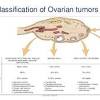 Ovarian cancer is the 5th deadliest. 1
