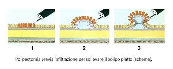 L'alimentazione dovrà essere del tutto regolare, evitando esclusivamente pasti eccessivi ed abbondati in cibi grassi. Terapia Endoscopica Dei Polipi Intestinali Roma Gastroenterologo Dott Prof Antonio Iannetti