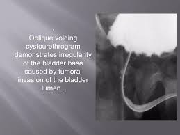 Image result for Voiding Cystourethrogram