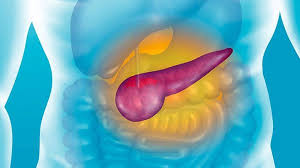 The earlier pancreatic cancer is diagnosed and treated, the better the prognosis. Experts Advise Against Pancreatic Cancer Screening Everyday Health