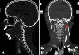 Closed Reduction Of Traumatic Atlantoaxial Rotatory Subluxation With Type Ii Odontoid Fracture Sciencedirect
