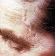 Image result for Jaw Claudication