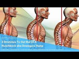 It can arise from a variety . Best Stretches To Get Rid Of A Hunchback Aka Dowagers Hump Exercises Posture Fixes More