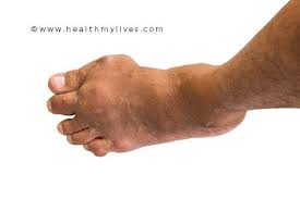 The most common symptom of bone tumors is pain. Bone Cancer Causes Symptoms Treatment Prevention