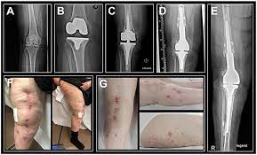 Frontiers Diagnosis Of Metal Hypersensitivity In Total Knee Arthroplasty A Case Report Immunology