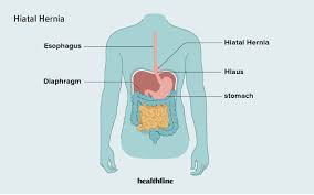 Image result for stomach hernia symptoms