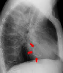 Eine herzmuskelentzündung (myokarditis) ist eine entzündliche erkrankung des herzmuskels. Kardiologie Rontgen Thorax Thorax Ct Kardio Ct Kardio Mr