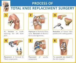 Medical Tourism In India Medi Mantra Healthcare Total Knee Replacement Surgery In India Knee Replacement Knee Replacement Surgery Total Knee Replacement