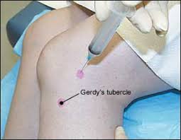 Image result for Prepatellar Bursa Injection