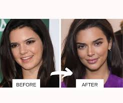 Before and after photos | on february 4, 2017 by pimmy watson. 25 Most Popular Celebrities With Lip Fillers Before And After With Images
