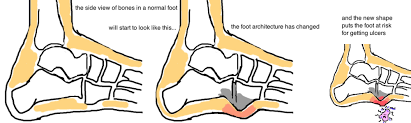 Charcot foot, also called charcot arthropathy, is a disease that attacks the bones, joints, and soft tissue in your feet. Charcot Foot Bone Talks