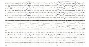 Example Of A Frontal Only Electroencephalographic Eeg