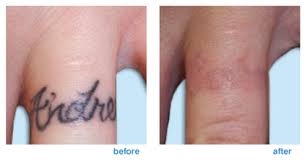 Using a combination of picosecond and nanosecond laser energy delivery, the piqo4 is today's most advanced laser tattoo removal treatment. Laser Tattoo Removal The Dermatology Specialists