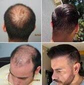 Good surgeons who specialize in Body and Beard hair grafts to scalp