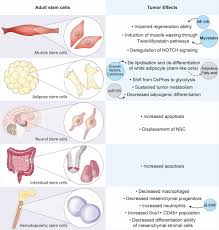 Image result for Cachexia in Cancer