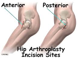 Use amazon prime to qualify for free shipping, otherwise shipping is free with $25. Artificial Hip Dislocation Precautions Eorthopod Com